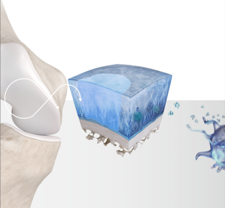 Nowa, innowacyjna metoda ortobiologiczna – Wdrożenie techniki remodelingu wypełnień chrzęstnych stawów leczonych poprzez implantacje scaffoldu wzbogaconego komórkami mezenchymalnymi szpiku kostnego